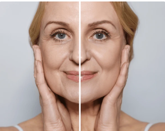 Before and after results using red light therapy face mask